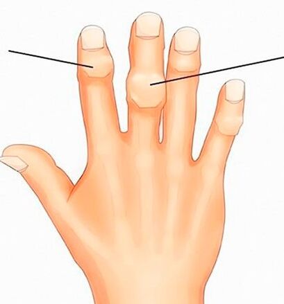 Heberden-en eta Bouchard-en nodoak artrosia duten interfalangeen artikulazioetan