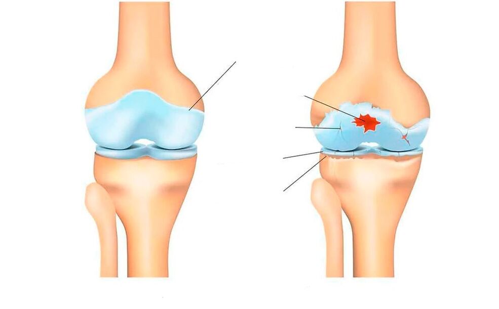 artikulazio osasuntsu eta artrosiarekin