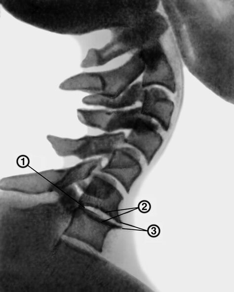 Trápaga bizkarrezurra osteokondrosia duen X izpiak