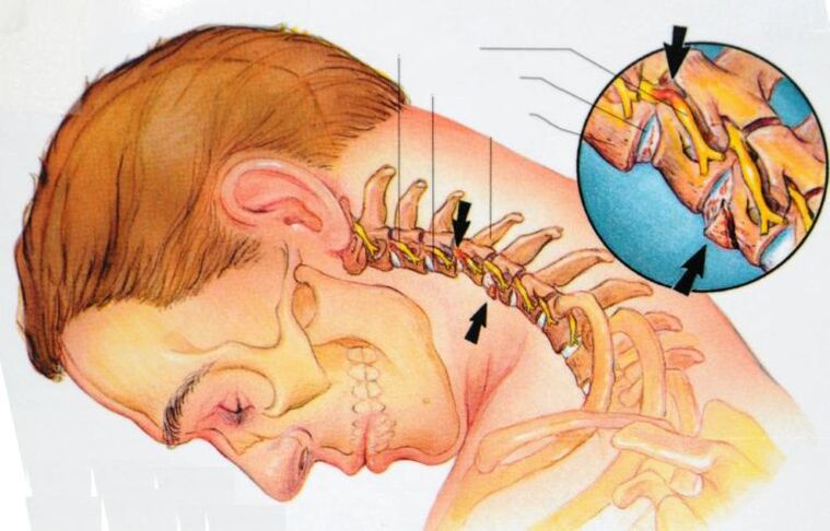 Trápaga osteokondrosiaren sintomak