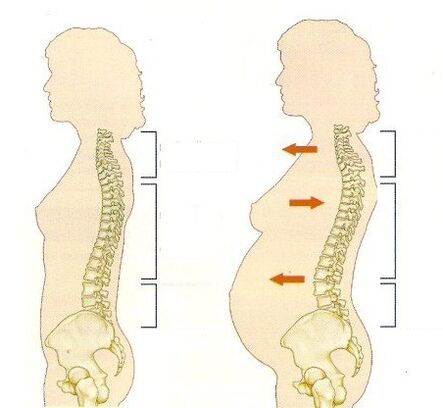 osteokondrosia haurdunaldian