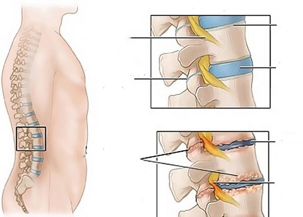 osteokondrosiaren ondorioz diskoetan izandako aldaketak